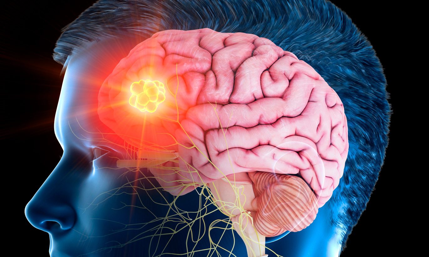 Early Signs of Brain Tumors